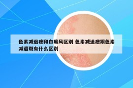 色素減退痣和白癜風區(qū)別 色素減退痣跟色素減退斑有什么區(qū)別
