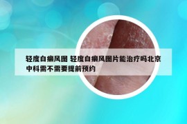 輕度白癩風(fēng)圖 輕度白癩風(fēng)圖片能治療嗎北京中科需不需要提前預(yù)約