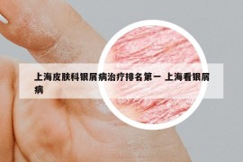 上海皮膚科銀屑病治療排名第一 上海看銀屑病