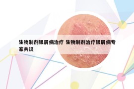 生物制劑銀屑病治療 生物制劑治療銀屑病專家共識