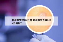 銀屑病導(dǎo)致scc升高 銀屑病會導(dǎo)致scca升高嗎?