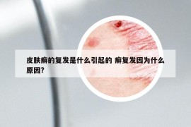 皮膚癬的復(fù)發(fā)是什么引起的 癬復(fù)發(fā)因為什么原因?