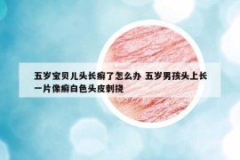 五歲寶貝兒頭長癬了怎么辦 五歲男孩頭上長一片像癬白色頭皮刺撓