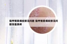 指甲銀屑病皮膚沒問題 指甲銀屑病皮膚沒問題但是很疼