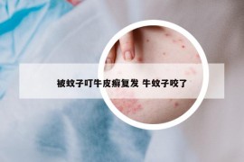 被蚊子叮牛皮癬復(fù)發(fā) 牛蚊子咬了