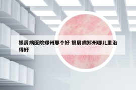銀屑病醫(yī)院鄭州那個(gè)好 銀屑病鄭州哪兒里治得好