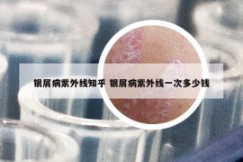 銀屑病紫外線知乎 銀屑病紫外線一次多少錢
