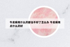 牛皮癬用什么藥都治不好了怎么辦 牛皮癬用點(diǎn)什么藥好
