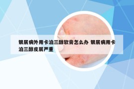 銀屑病外用卡泊三醇軟膏怎么辦 銀屑病用卡泊三醇皮屑嚴(yán)重
