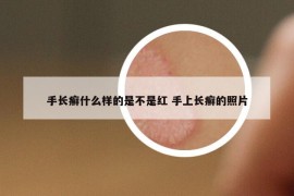 手長癬什么樣的是不是紅 手上長癬的照片
