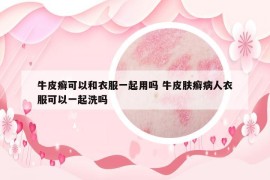 牛皮癬可以和衣服一起用嗎 牛皮膚癬病人衣服可以一起洗嗎