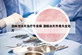 酒精泡冰片治療牛皮癬 酒精冰片外用大全處方