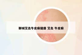 聊城艾灸牛皮癬健康 艾灸 牛皮癬