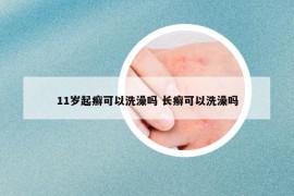 11歲起癬可以洗澡嗎 長(zhǎng)癬可以洗澡嗎