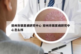 鄭州市銀屑病研究中心 鄭州市銀屑病研究中心怎么樣