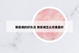 銀屑病的好辦法 銀屑病怎么效果最好