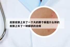 皮膚皮膚上長(zhǎng)了一個(gè)大的那個(gè)癬是什么樣的 皮膚上長(zhǎng)了一塊癬狀的會(huì)癢