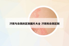 汗斑與白斑的區(qū)別圖片大全 汗斑和白斑區(qū)別