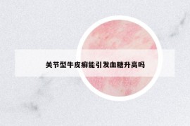 關(guān)節(jié)型牛皮癬能引發(fā)血糖升高嗎