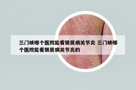 三門峽哪個(gè)醫(yī)院能看銀屑病關(guān)節(jié)炎 三門峽哪個(gè)醫(yī)院能看銀屑病關(guān)節(jié)炎的
