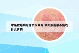 掌跖膿皰病吃什么水果好 掌跖膿皰病不能吃什么食物