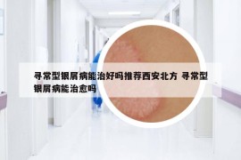 尋常型銀屑病能治好嗎推薦西安北方 尋常型銀屑病能治愈嗎