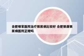 合肥哪家醫(yī)院治療銀屑病比較好 合肥銀康銀屑病醫(yī)院正規(guī)嗎