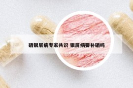 硒銀屑病專家共識(shí) 銀屑病要補(bǔ)硒嗎