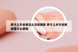 脖子上牛皮癬怎么沒有鱗屑 脖子上長(zhǎng)牛皮膚癬是什么原因