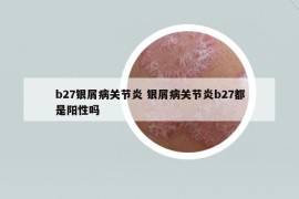 b27銀屑病關(guān)節(jié)炎 銀屑病關(guān)節(jié)炎b27都是陽(yáng)性嗎