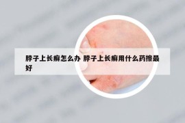 脖子上長癬怎么辦 脖子上長癬用什么藥擦最好