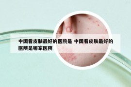 中國看皮膚最好的醫(yī)院是 中國看皮膚最好的醫(yī)院是哪家醫(yī)院