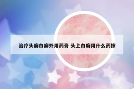 治療頭癬白癬外用藥膏 頭上白癬用什么藥擦