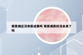 銀屑病還沒(méi)有新進(jìn)展嗎 銀屑病真的沒(méi)未來(lái)了嗎