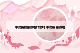 牛皮癬摸酮康唑好使嗎 牛皮癬 酮康唑