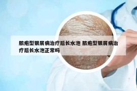膿皰型銀屑病治療后長(zhǎng)水泡 膿皰型銀屑病治療后長(zhǎng)水泡正常嗎