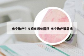 南寧治療牛皮癬有哪些醫(yī)院 南寧治療銀屑病