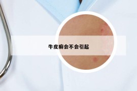牛皮癬會不會引起