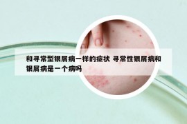 和尋常型銀屑病一樣的癥狀 尋常性銀屑病和銀屑病是一個(gè)病嗎