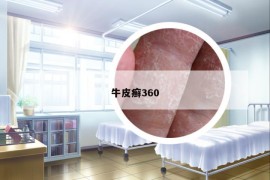 牛皮癬360
