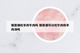 銀屑病吃羊肉牛肉嗎 銀屑病可以吃牛肉和羊肉湯嗎