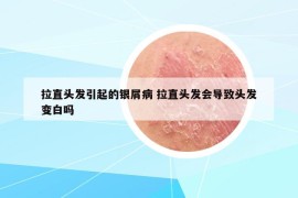 拉直頭發(fā)引起的銀屑病 拉直頭發(fā)會(huì)導(dǎo)致頭發(fā)變白嗎