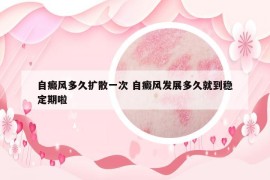 自癜風多久擴散一次 自癜風發(fā)展多久就到穩(wěn)定期啦