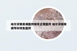 哈爾濱銀屑病醫(yī)院哪家正規(guī)醫(yī)院 哈爾濱銀屑病?？铺厣t(yī)院