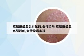 皮膚癬是怎么引起的,會(huì)傳染嗎 皮膚癬是怎么引起的,會(huì)傳染嗎小孩