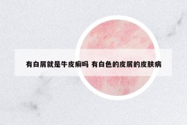 有白屑就是牛皮癬嗎 有白色的皮屑的皮膚病