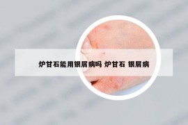 爐甘石能用銀屑病嗎 爐甘石 銀屑病