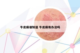 牛皮癬誰知道 牛皮癬有辦法嗎