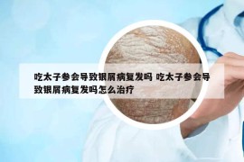 吃太子參會導(dǎo)致銀屑病復(fù)發(fā)嗎 吃太子參會導(dǎo)致銀屑病復(fù)發(fā)嗎怎么治療