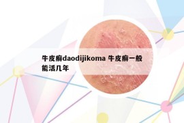 牛皮癬daodijikoma 牛皮癬一般能活幾年
